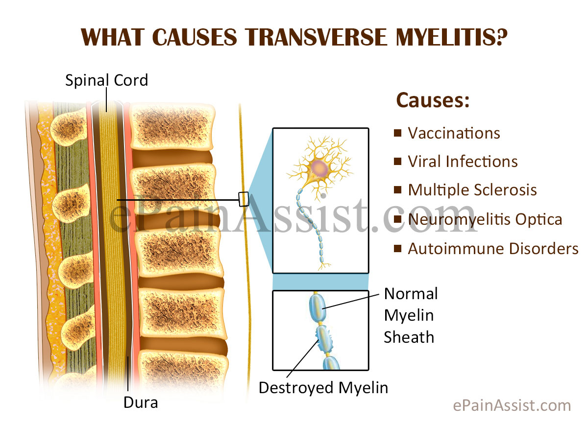 Causes Transverse Myelitis