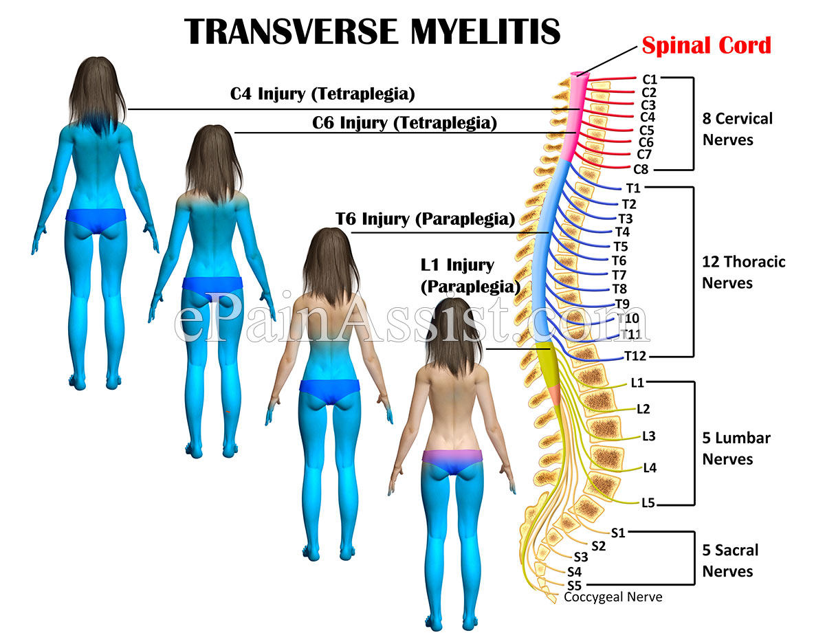 Transverse Myelitis Transverse Myelitis