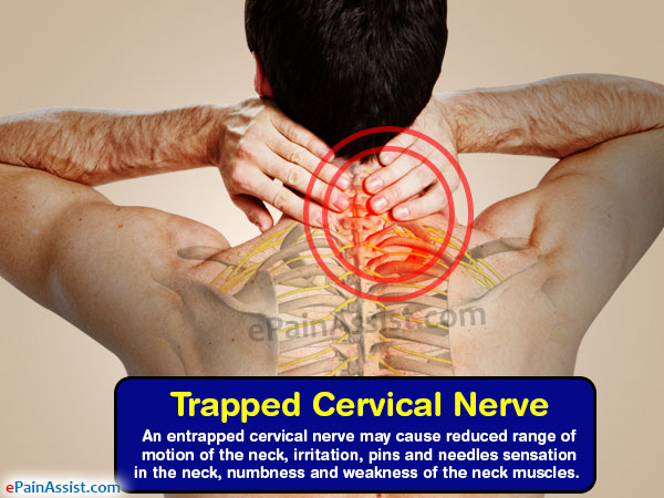 Trapped Cervical Nerve|Causes|Symptoms,|Treatment