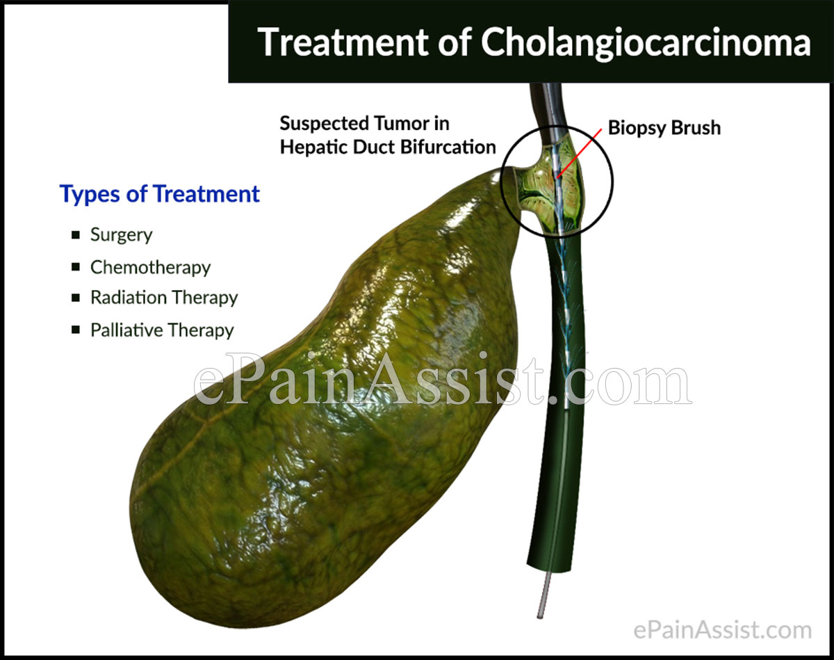 Treatment of Cholangiocarcinoma Treatment of Cholangiocarcinoma