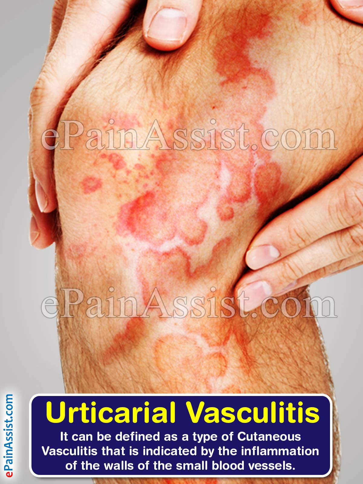 Urticarial Vasculitis Urticarial Vasculitis