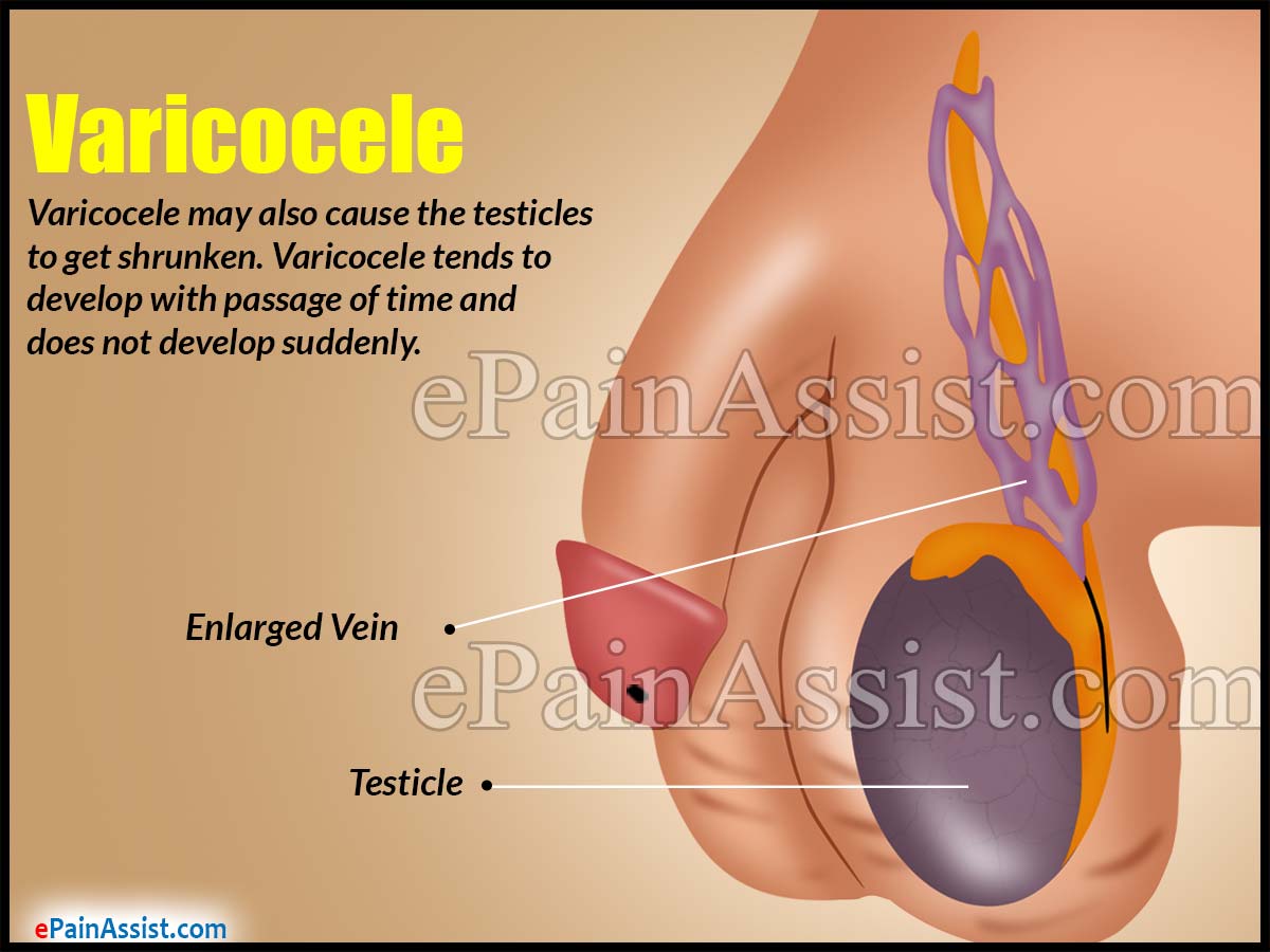 What Is Varicocele What Is Varicocele