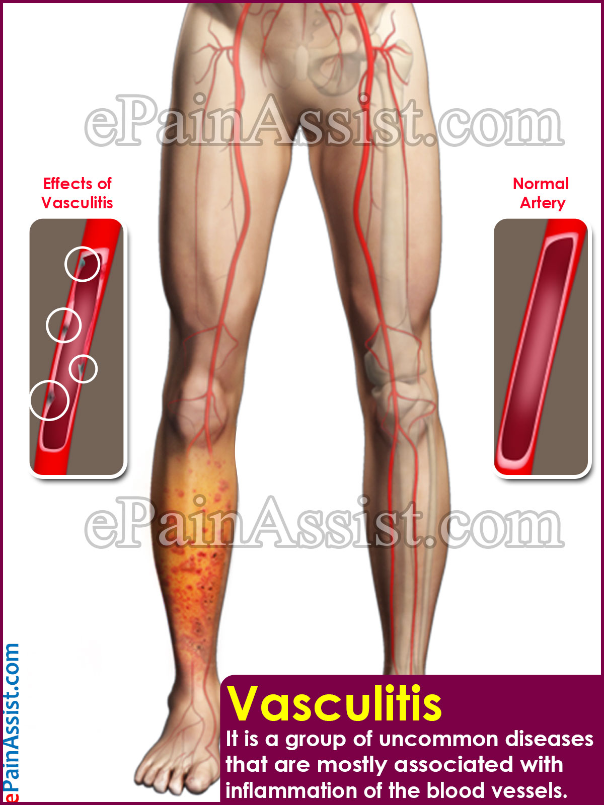 Vasculitis Vasculitis