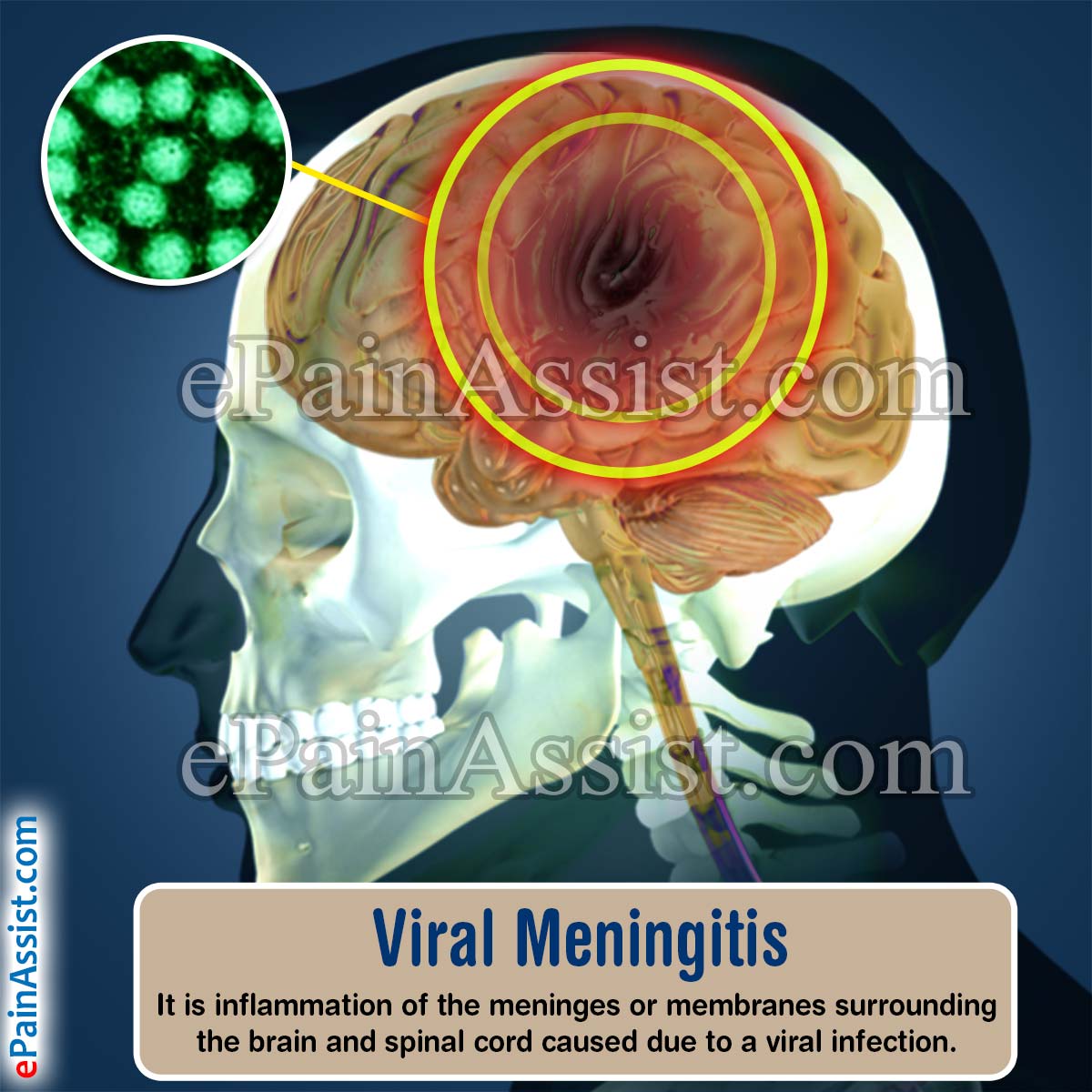 Viral Meningitis Viral Meningitis