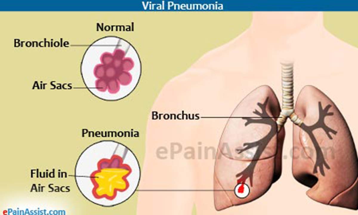 Viral Pneumonia Viral Pneumonia