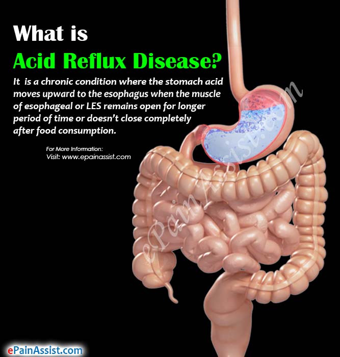 What is Acid Reflux Disease