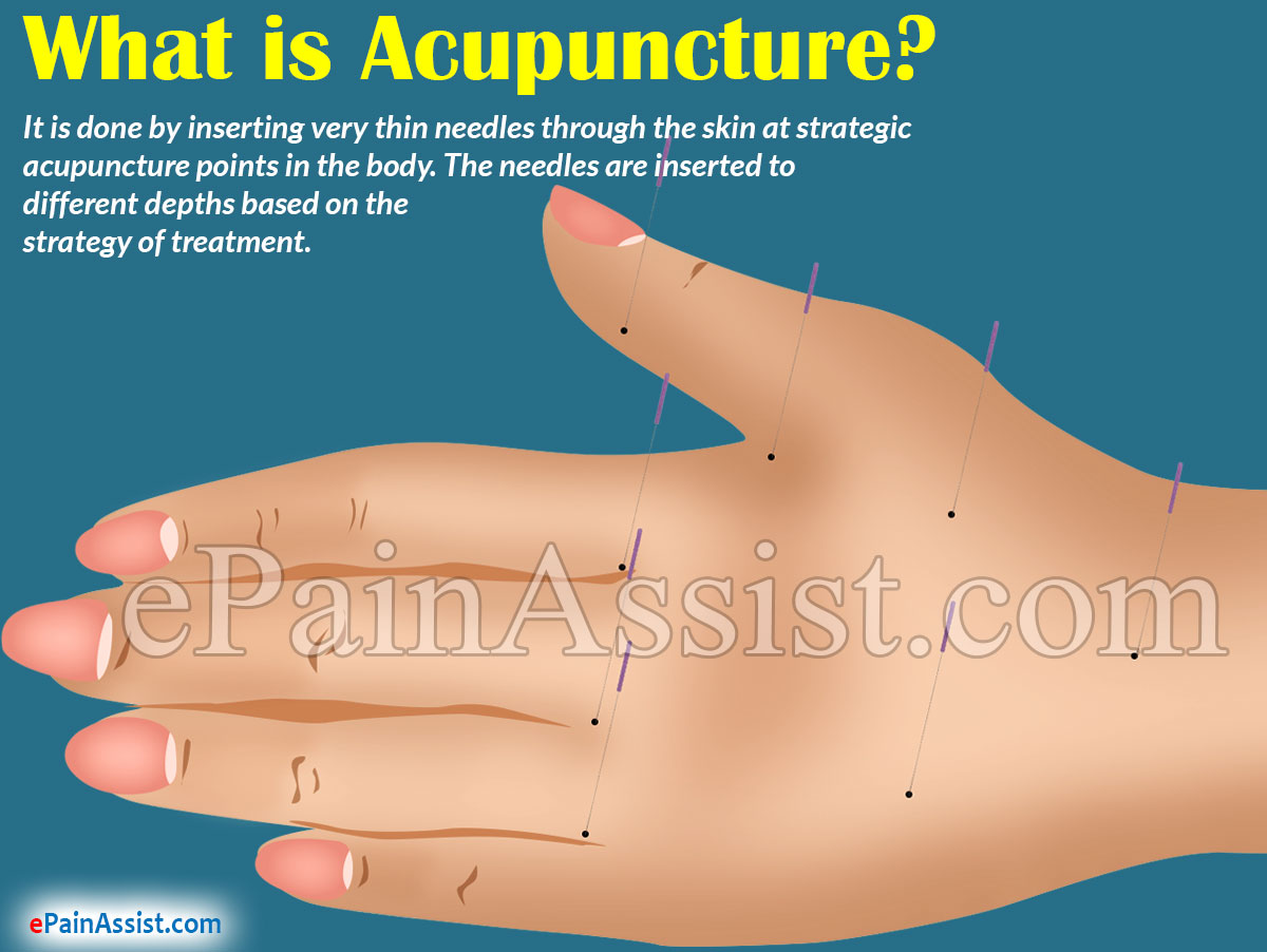 What is Acupuncture