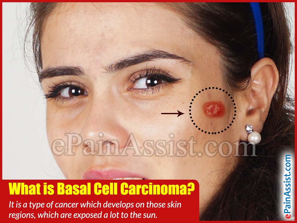What is Basal Cell Carcinoma What is Basal Cell Carcinoma