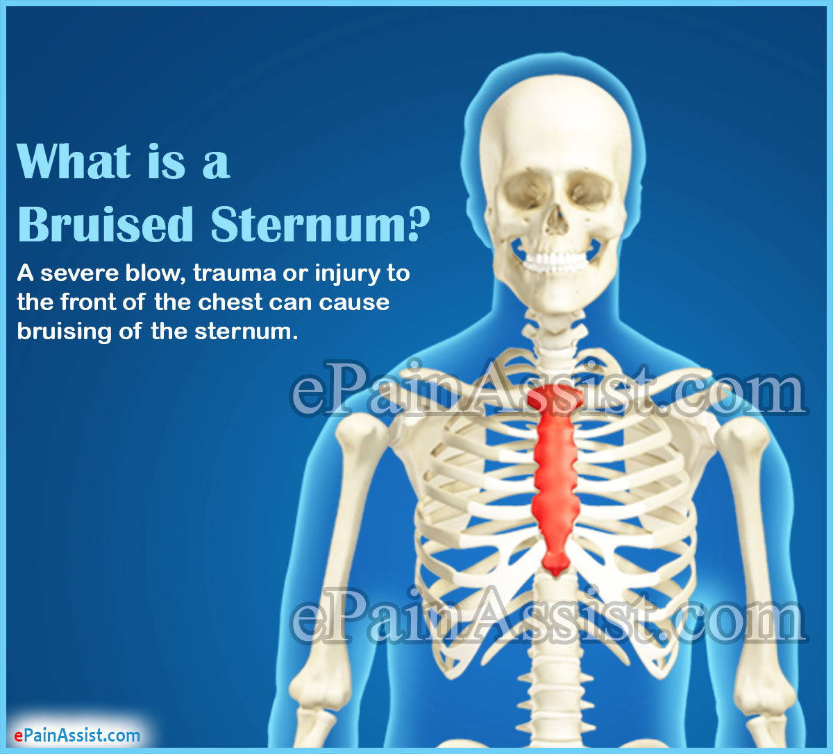 What is a Bruised Sternum What is a Bruised Sternum