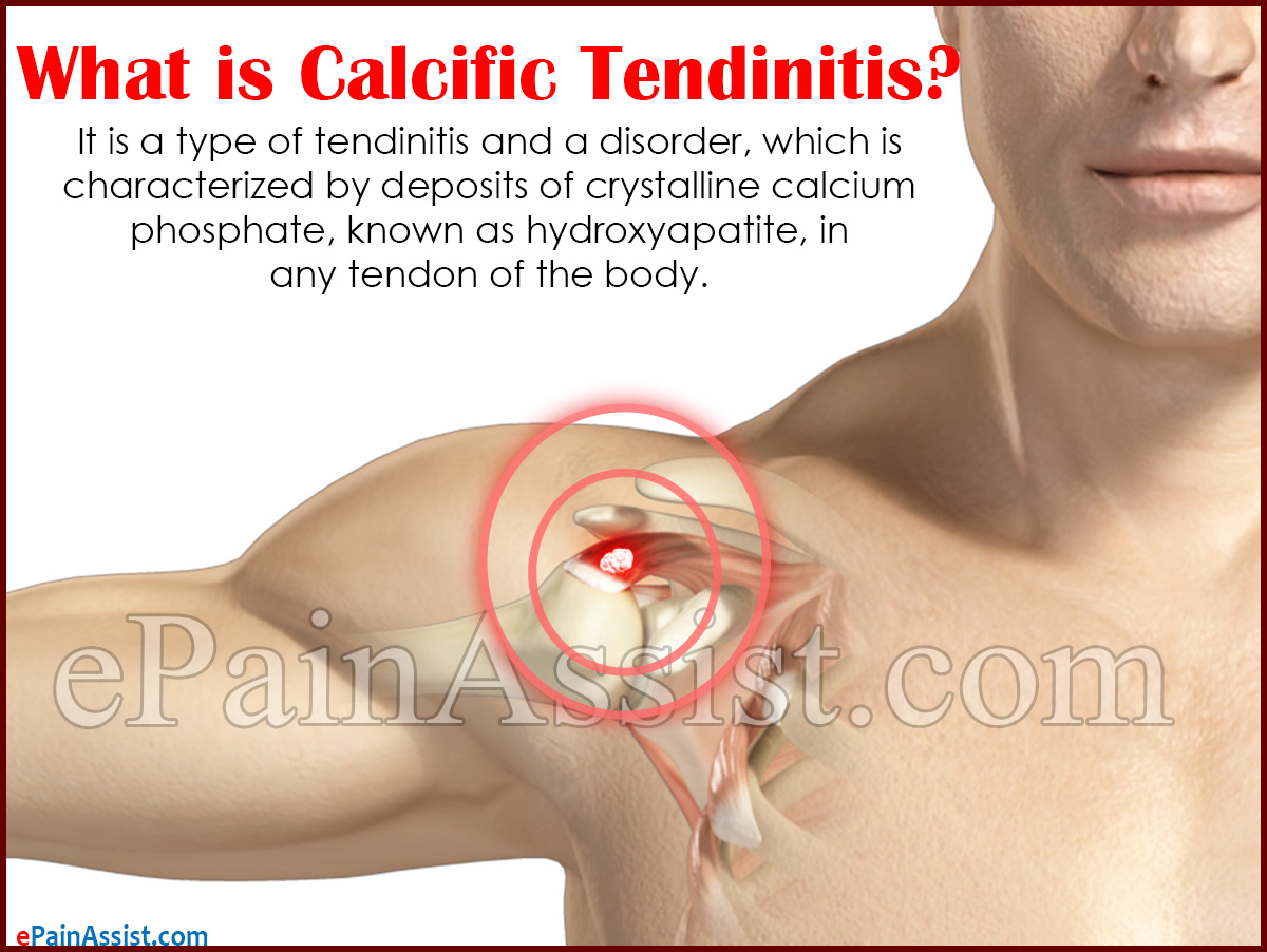 What is Calcific Tendinitis What is Calcific Tendinitis