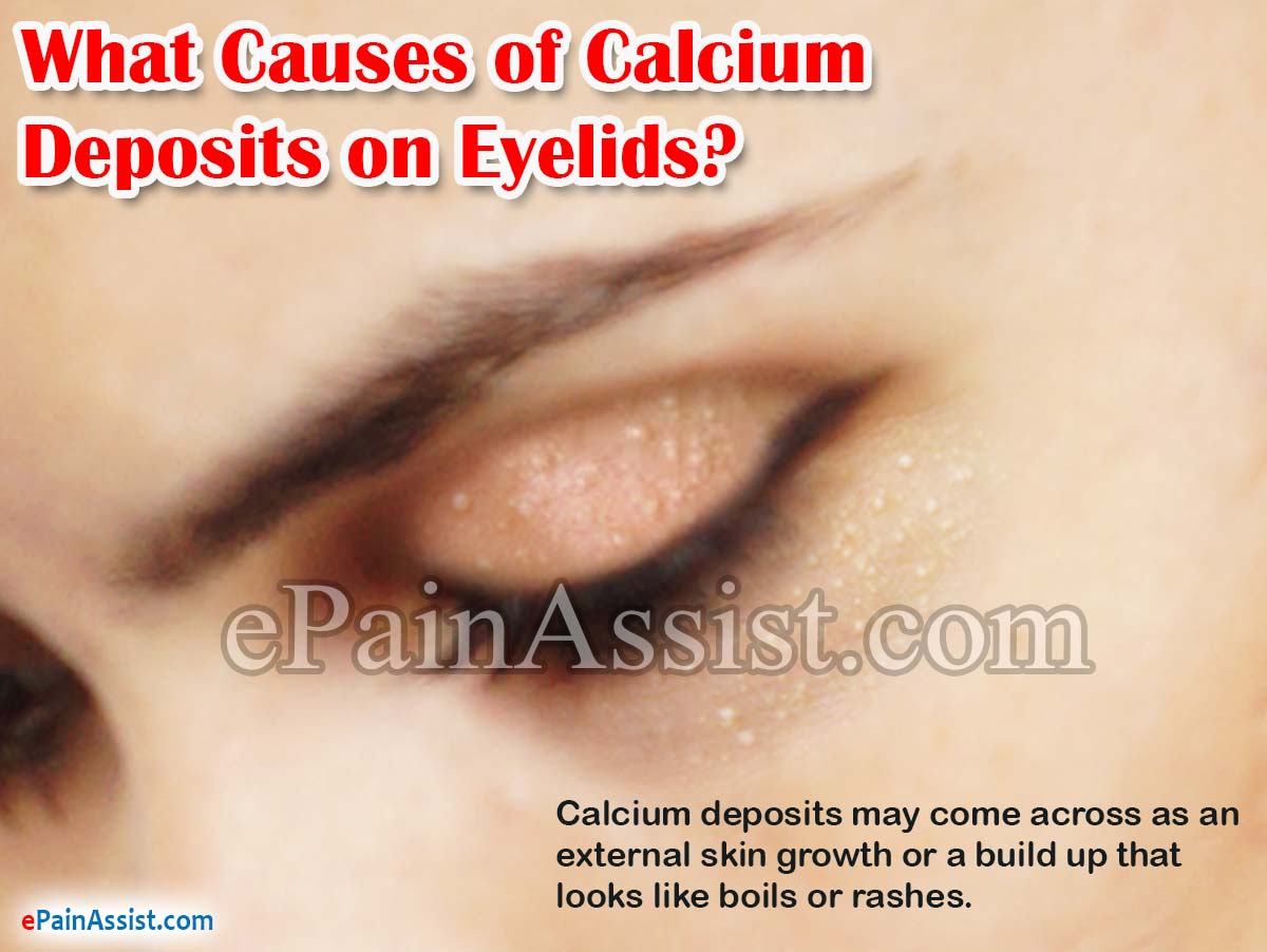 What Causes of Calcium Deposits on Eyelids