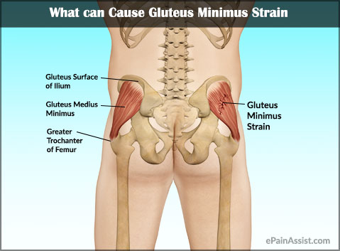 What Can Cause Gluteus Minimus Strain?