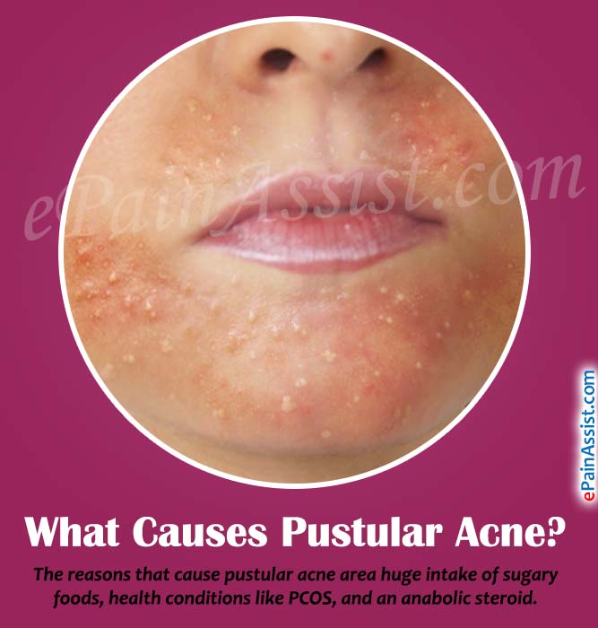 What Causes Pustular Acne