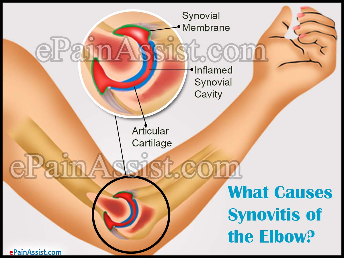 What Causes Synovitis of the Elbow What Causes Synovitis of the Elbow
