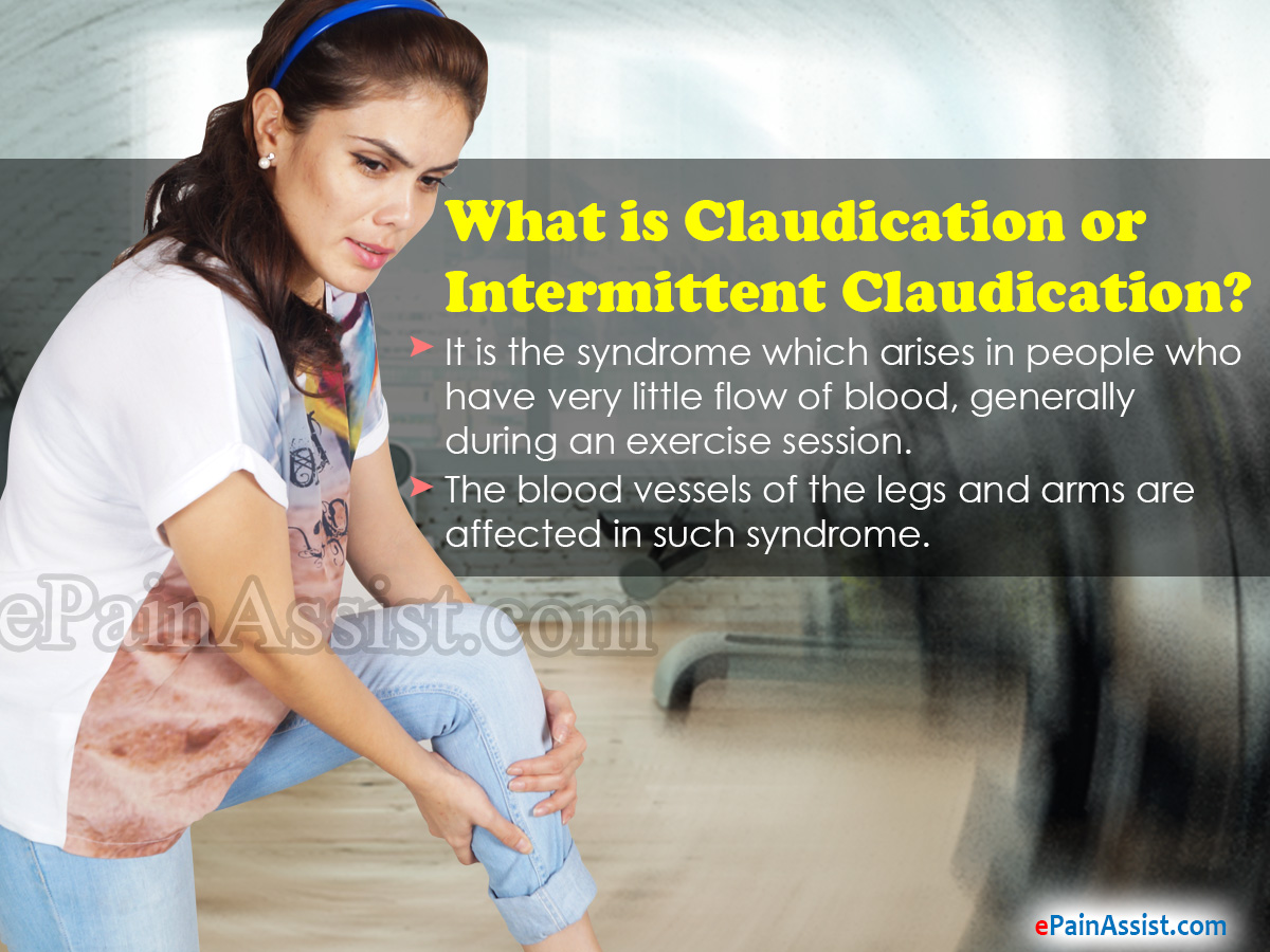 What is Claudication or Intermittent Claudication What is Claudication or Intermittent Claudication