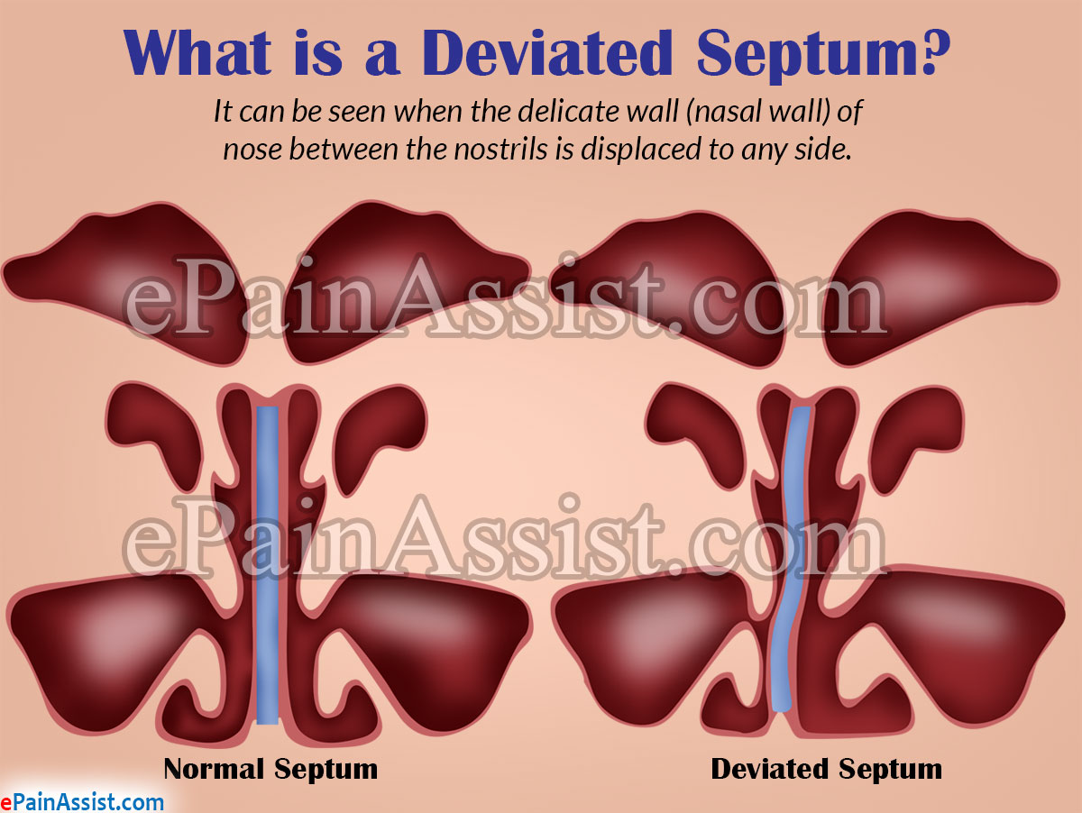 What is Deviated Septum or Septal Deviation? What is Deviated Septum or Septal Deviation?