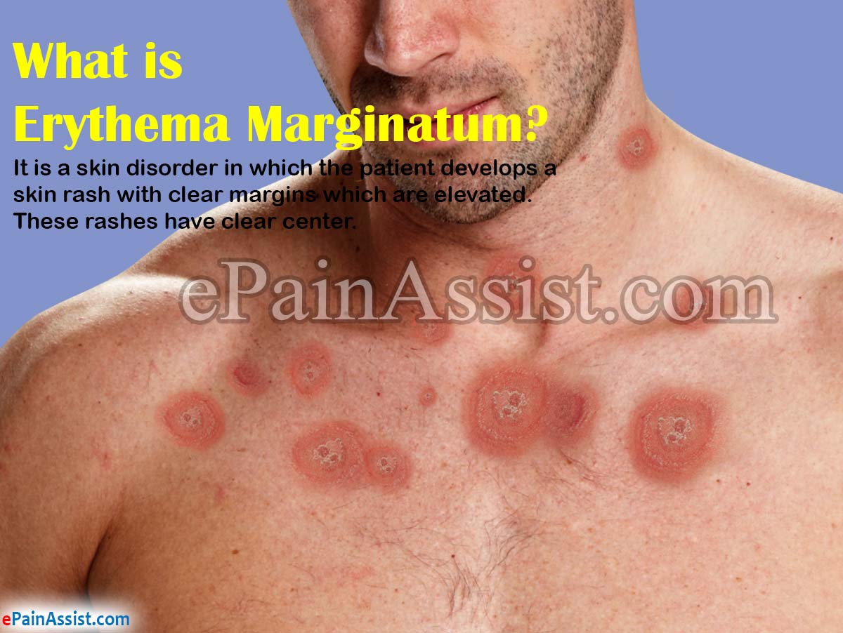 What Is Erythema Marginatum What Is Erythema Marginatum