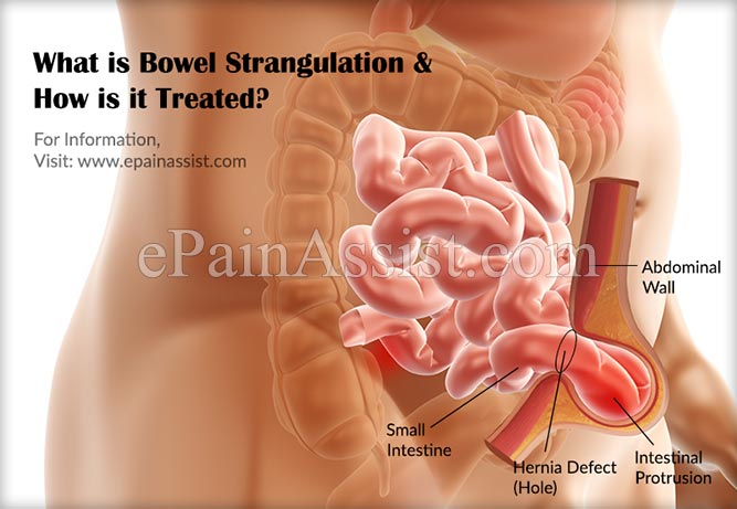 What is Bowel Strangulation & How is it Treated?