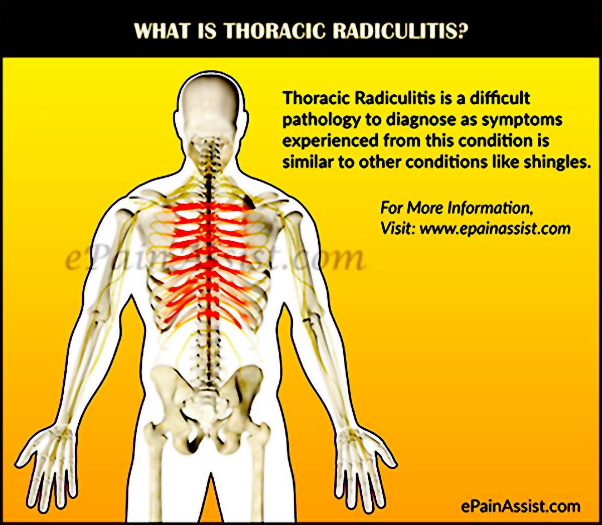 Thoracic Radiculitis