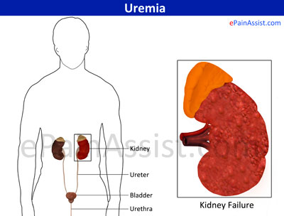 Causes and Risk Factors of Uremia