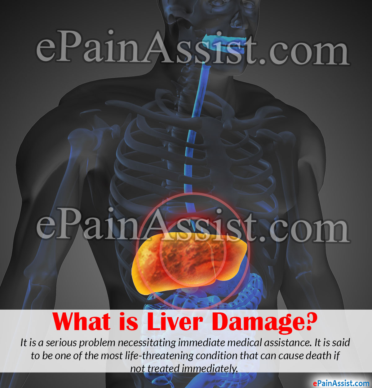 What is Liver Damage or Liver Failure