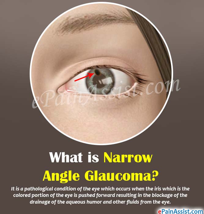 What is Narrow Angle Glaucoma?