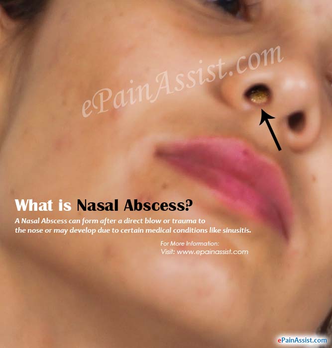 What is Nasal Abscess