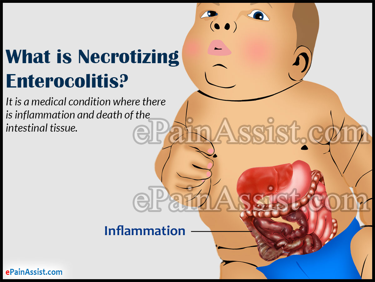 What is Necrotizing Enterocolitis