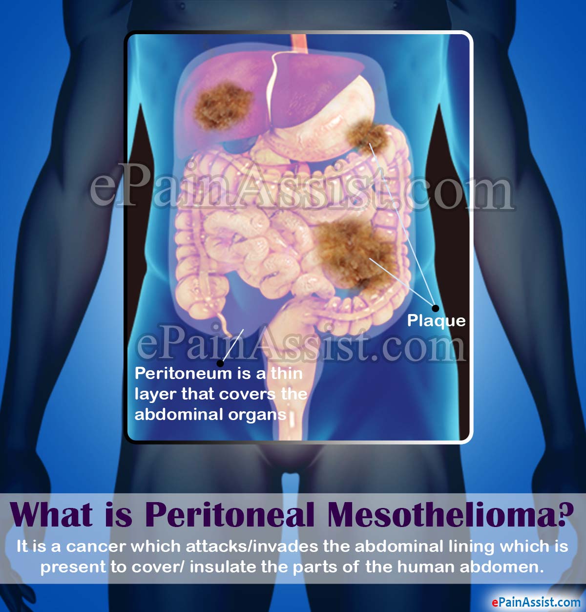 What is Peritoneal Mesothelioma What is Peritoneal Mesothelioma