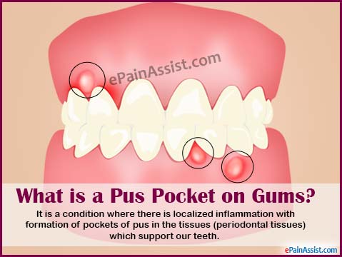 What is a Pus Pocket on Gums