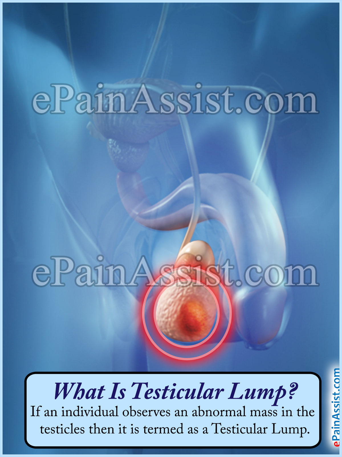 Testicular Lump Testicular Lump
