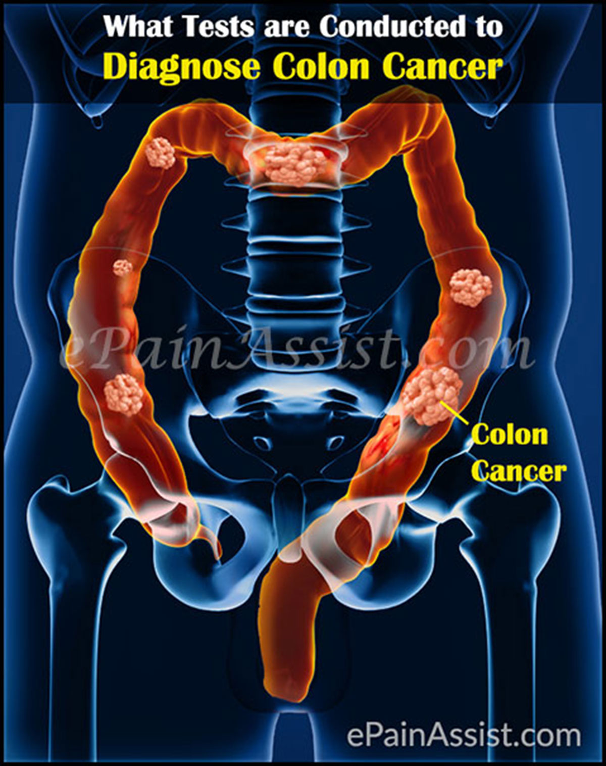What Tests are Conducted to Diagnose Colon Cancer What Tests are Conducted to Diagnose Colon Cancer