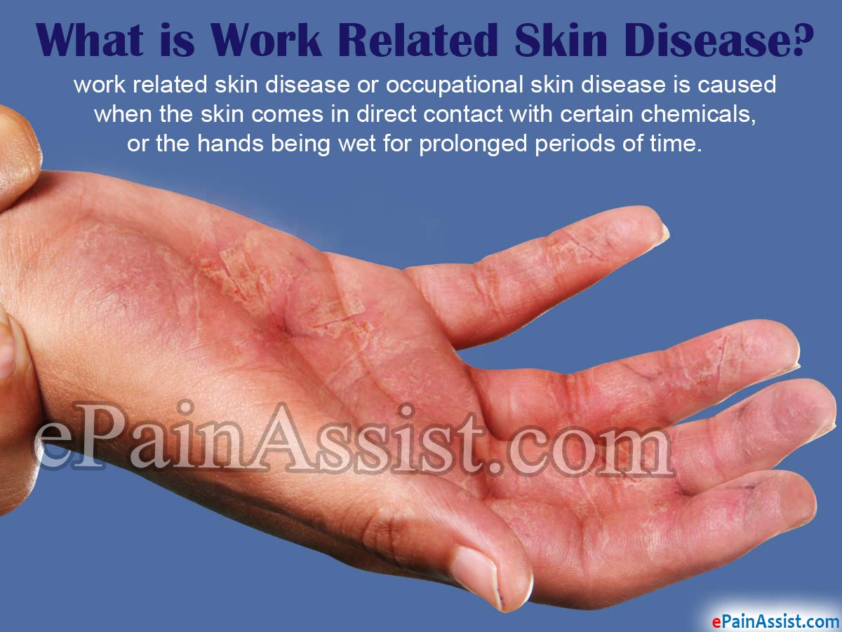 What is Work Related Skin Disease or Occupational Skin Disease? What is Work Related Skin Disease or Occupational Skin Disease?