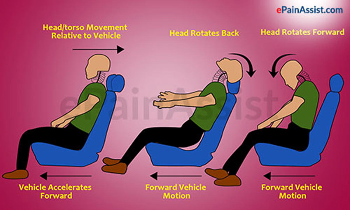 Whiplash Injury Whiplash Injury