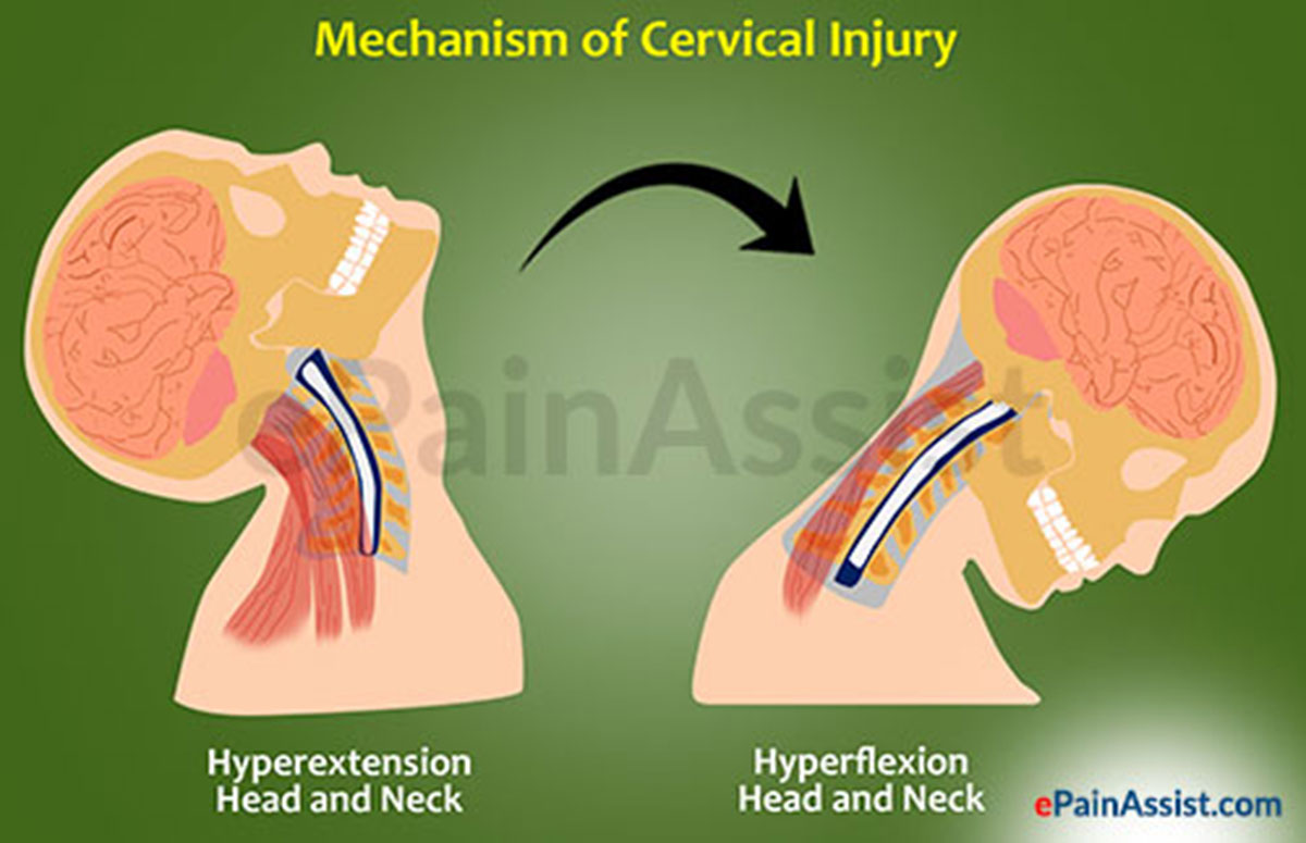 Neck Pain