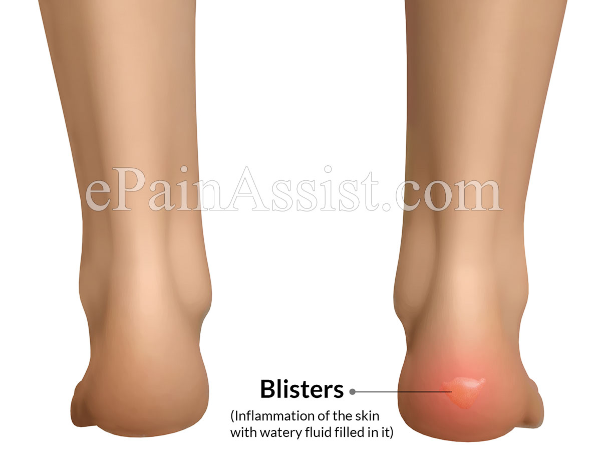 Blisters look red in color