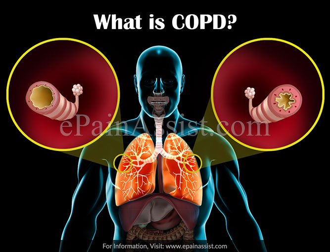 What is COPD?