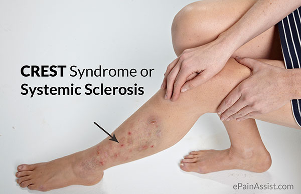 CREST Syndrome or Systemic Sclerosis|Types|Causes|Risk