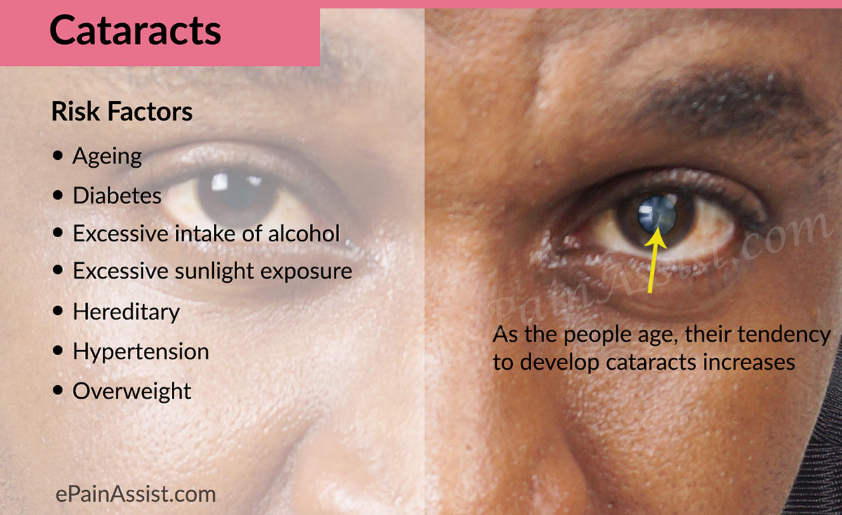 What causes cataracts?