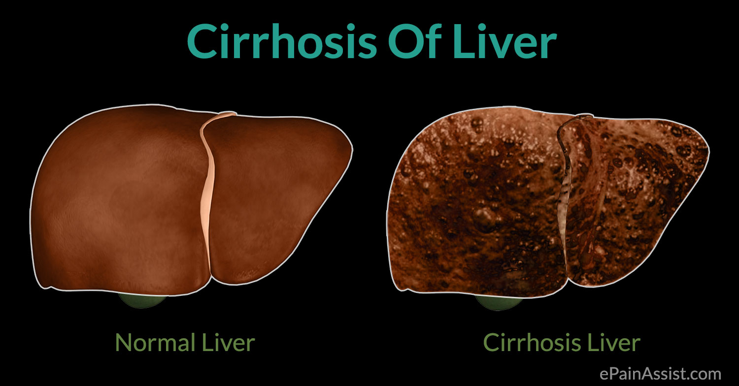 case study cirrhosis of the liver