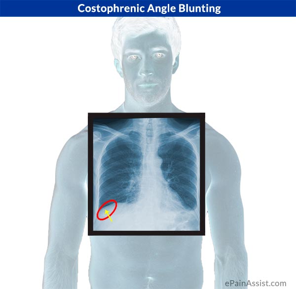 Costophrenic Angle Blunting