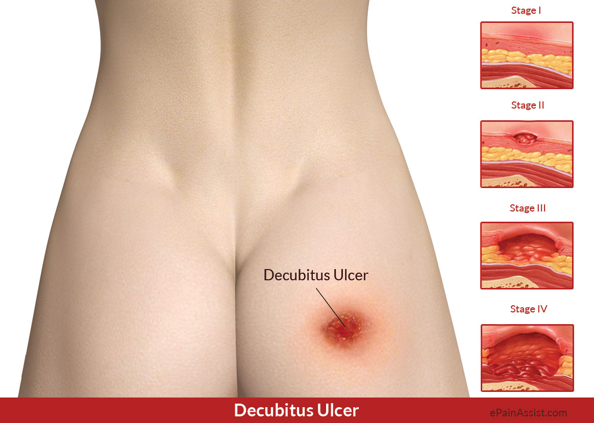 Decubitus Ulcer or Pressure Ulcer or Bedsores