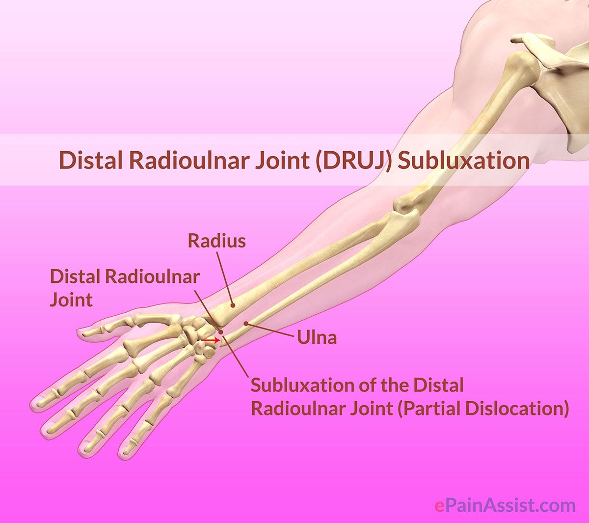 Distal Radioulnar Joint DRUJ Subluxation Types Causes Symptoms 