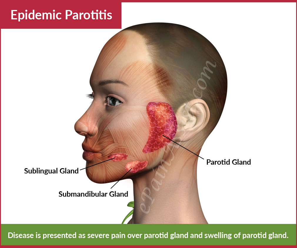 Parotid Gland Swelling Mumps
