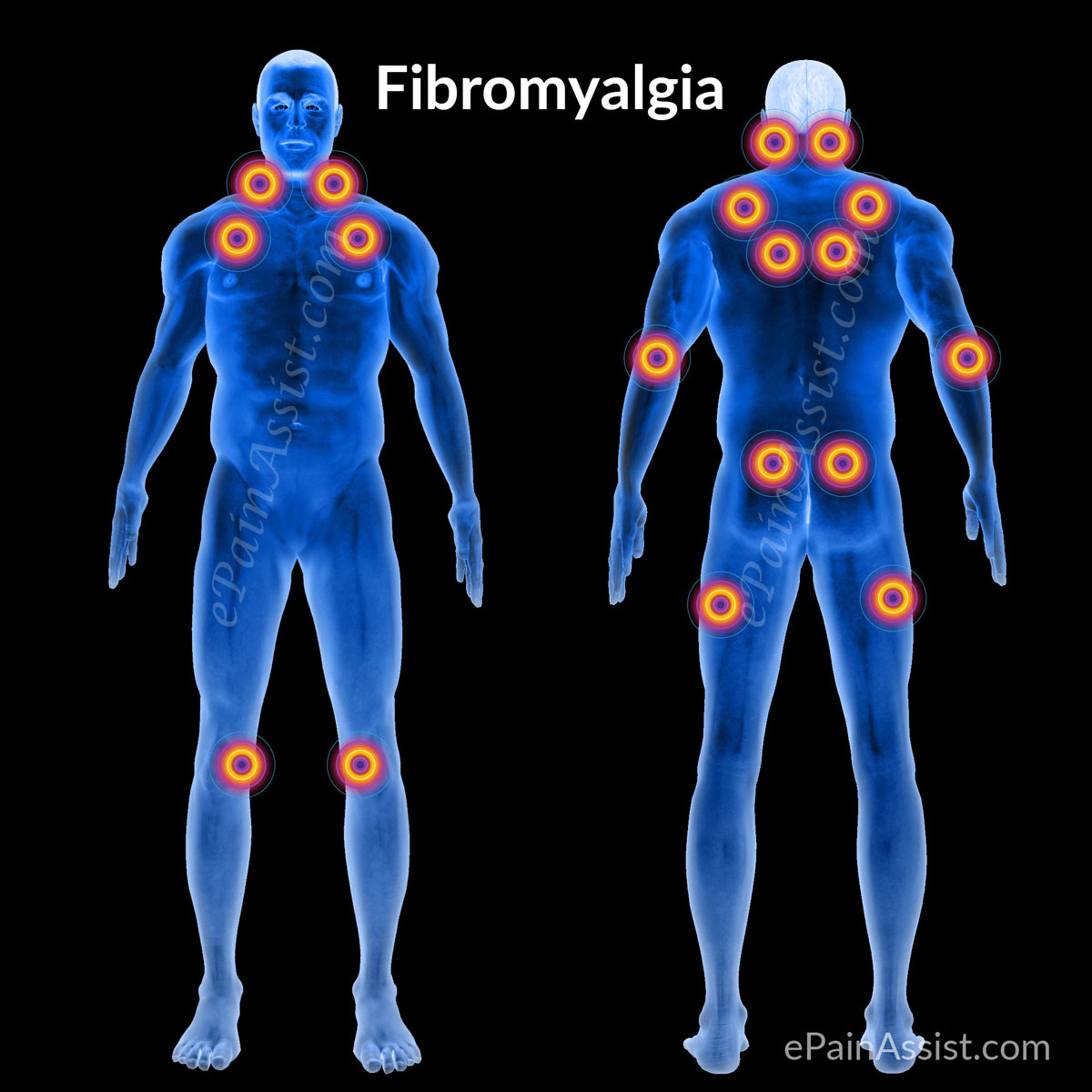FAQ On Fibromyalgia Symptoms 11 Painful Trigger Points Causes Risk Factors