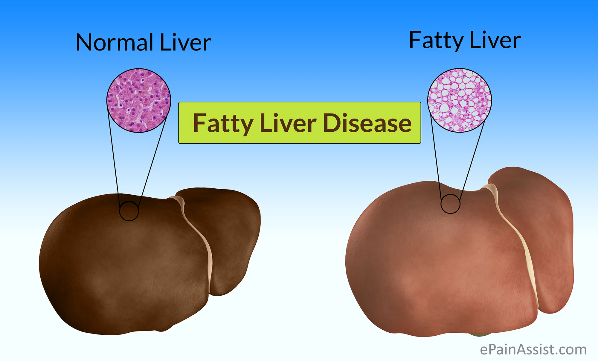 Fat Infiltration Of Liver 91