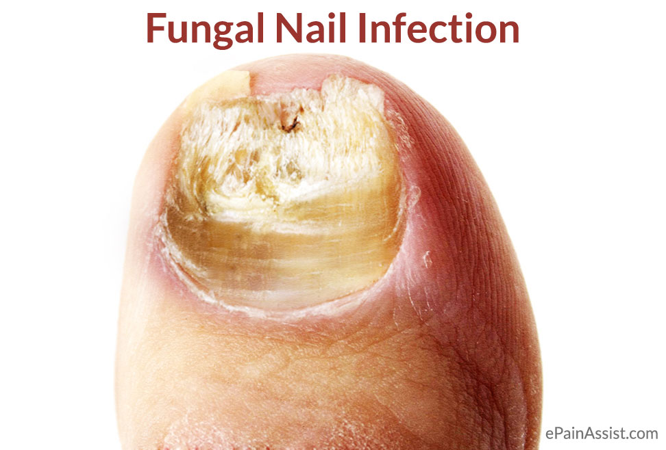 Fungal Nail Infection or Onychomycosis