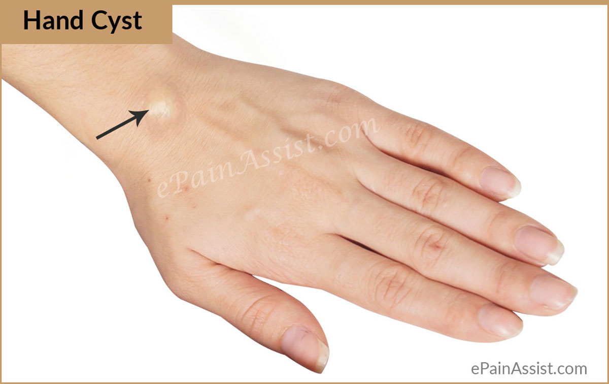 What Are The Symptoms Of Hand Cyst?