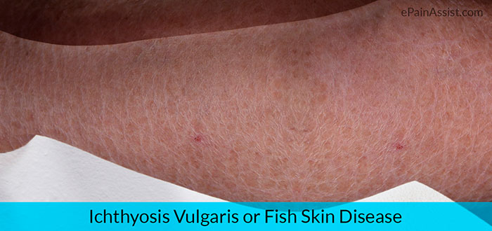 Ichthyosis Vulgaris or Fish Skin Disease or Fish Scale Disease