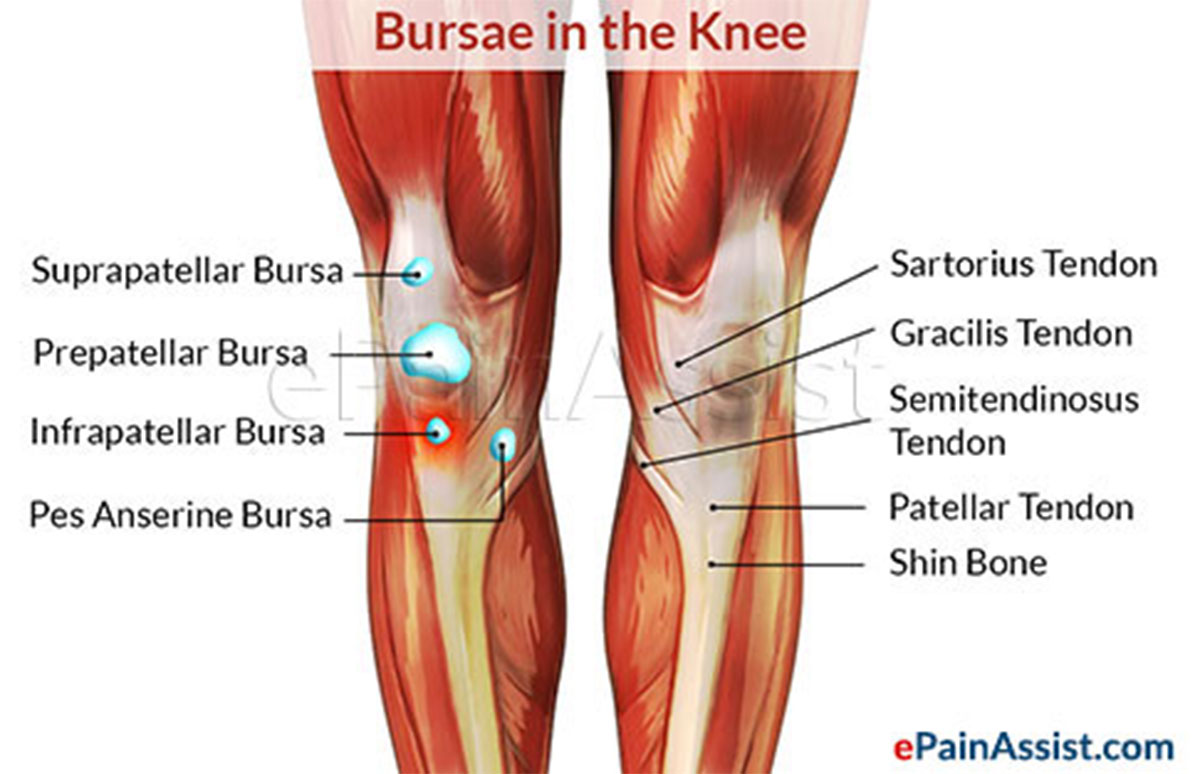 Infrapatellar Bursitis Infrapatellar Bursitis